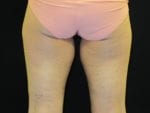 Coolsculpting - Case Case 1 - Before
