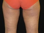 Coolsculpting - Case Case 1 - After