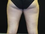 Coolsculpting - Case Case 2 - Before