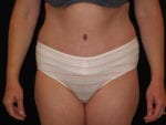 Tummy Tuck - Case Case 8 - After