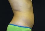 Coolsculpting - Case Case 3 - After