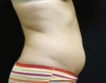 Coolsculpting - Case Case 3 - Before