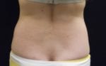 Coolsculpting - Case Case 4 - Before
