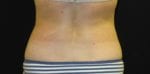 Coolsculpting - Case Case 4 - After