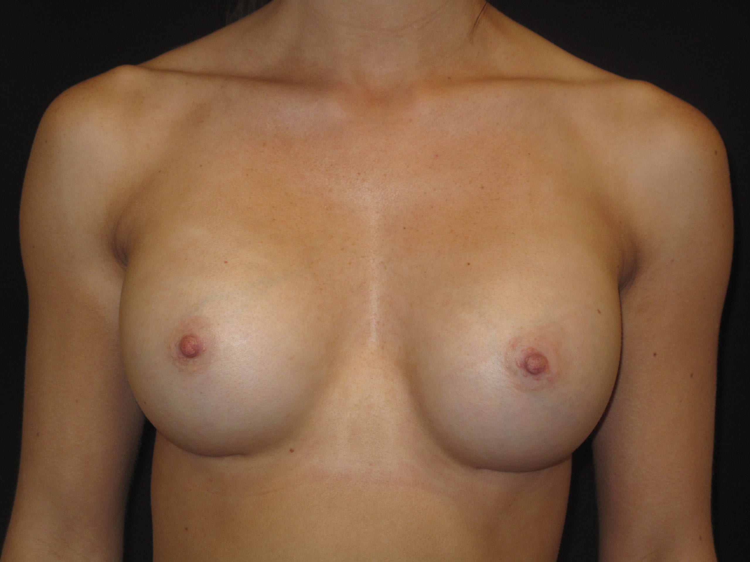 Breast Augmentation Patient Photo - Case Case 27 - after view-0