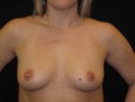 Breast Augmentation - Case Case 4 - Before