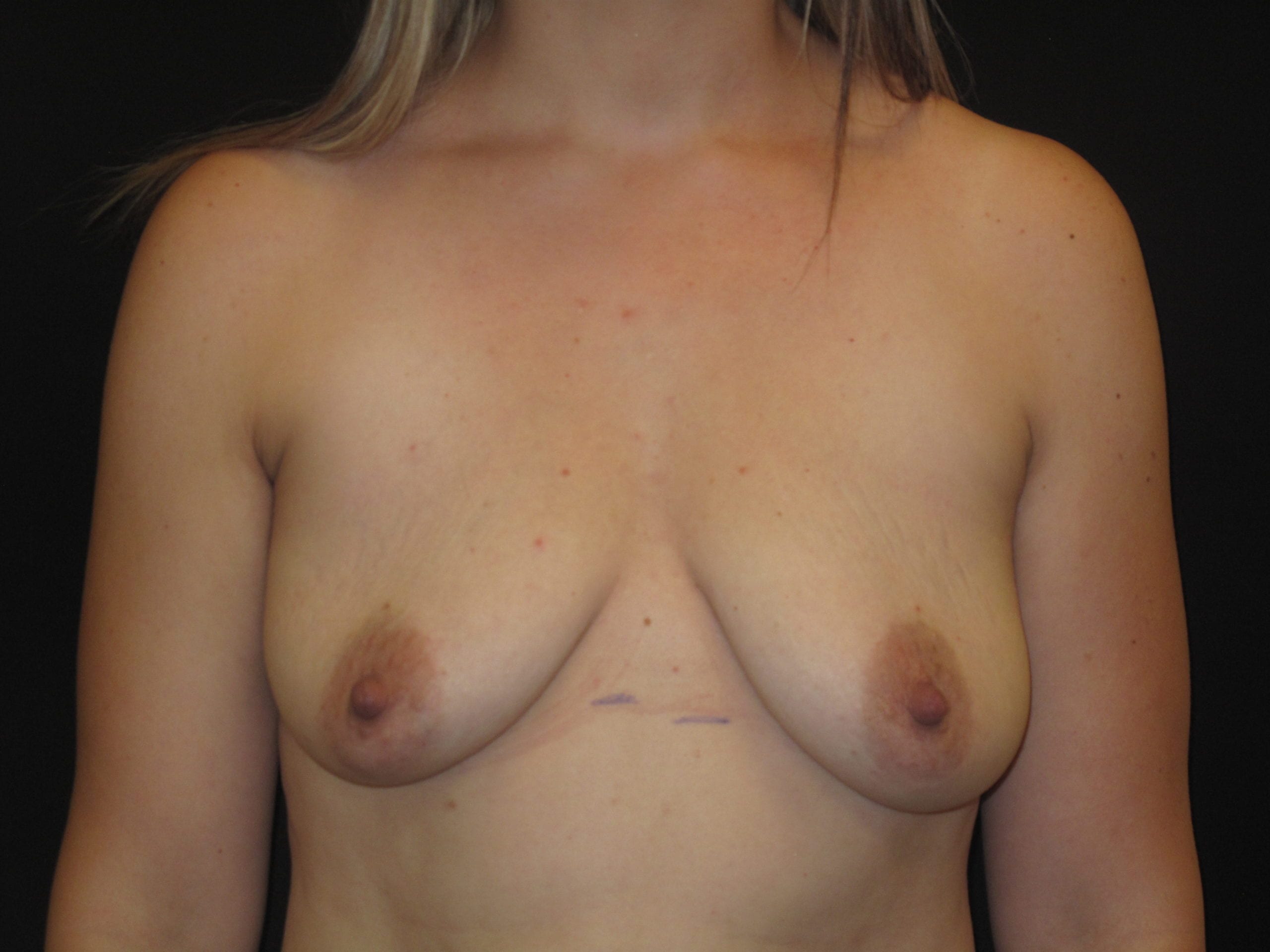 Breast Lift w/ Augmentation Patient Photo - Case Case 1 - before view-0