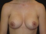 Breast Lift w/ Augmentation - Case Case 1 - After