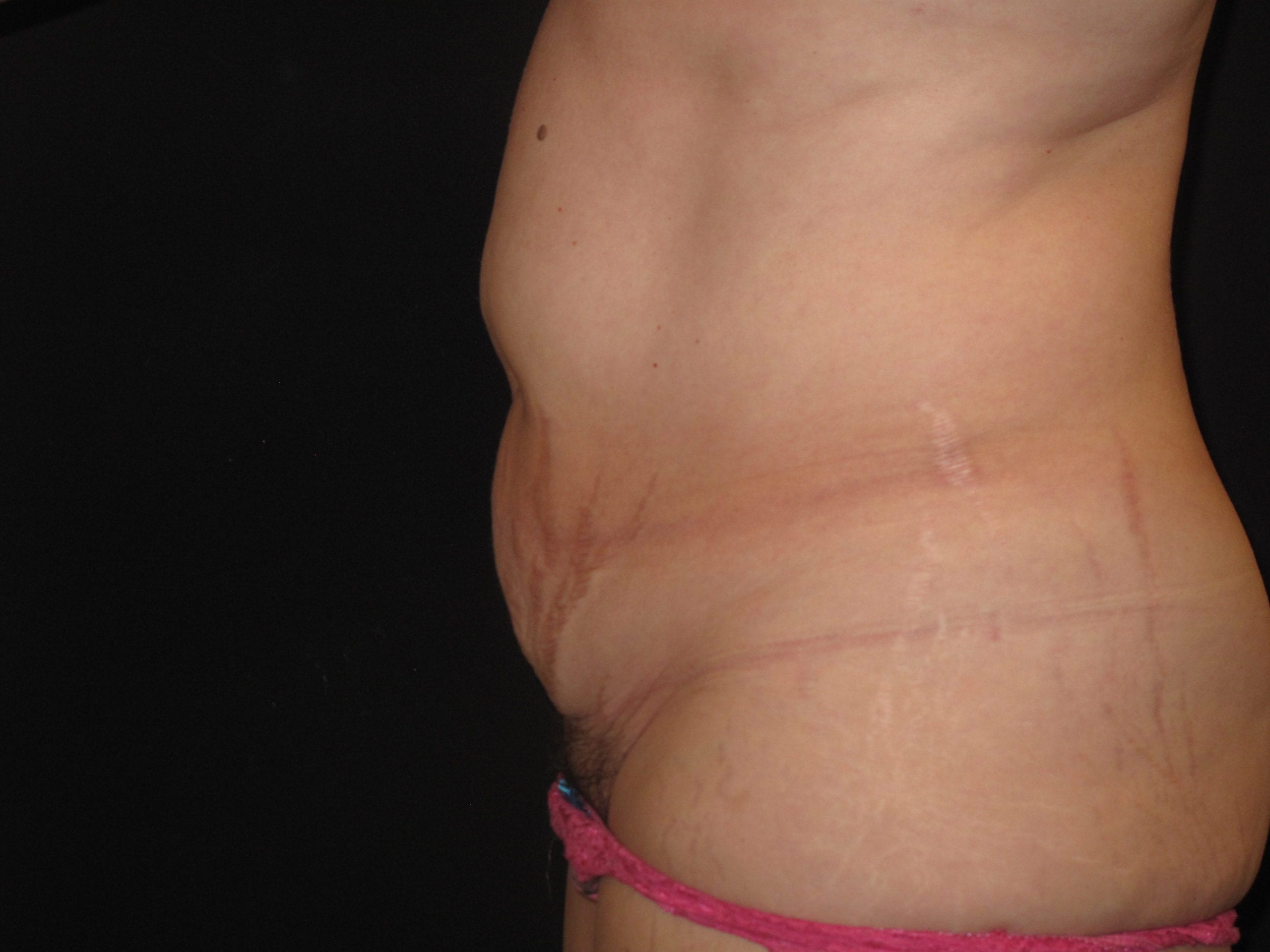 Tummy Tuck Patient Photo - Case Case 9 - before view-1