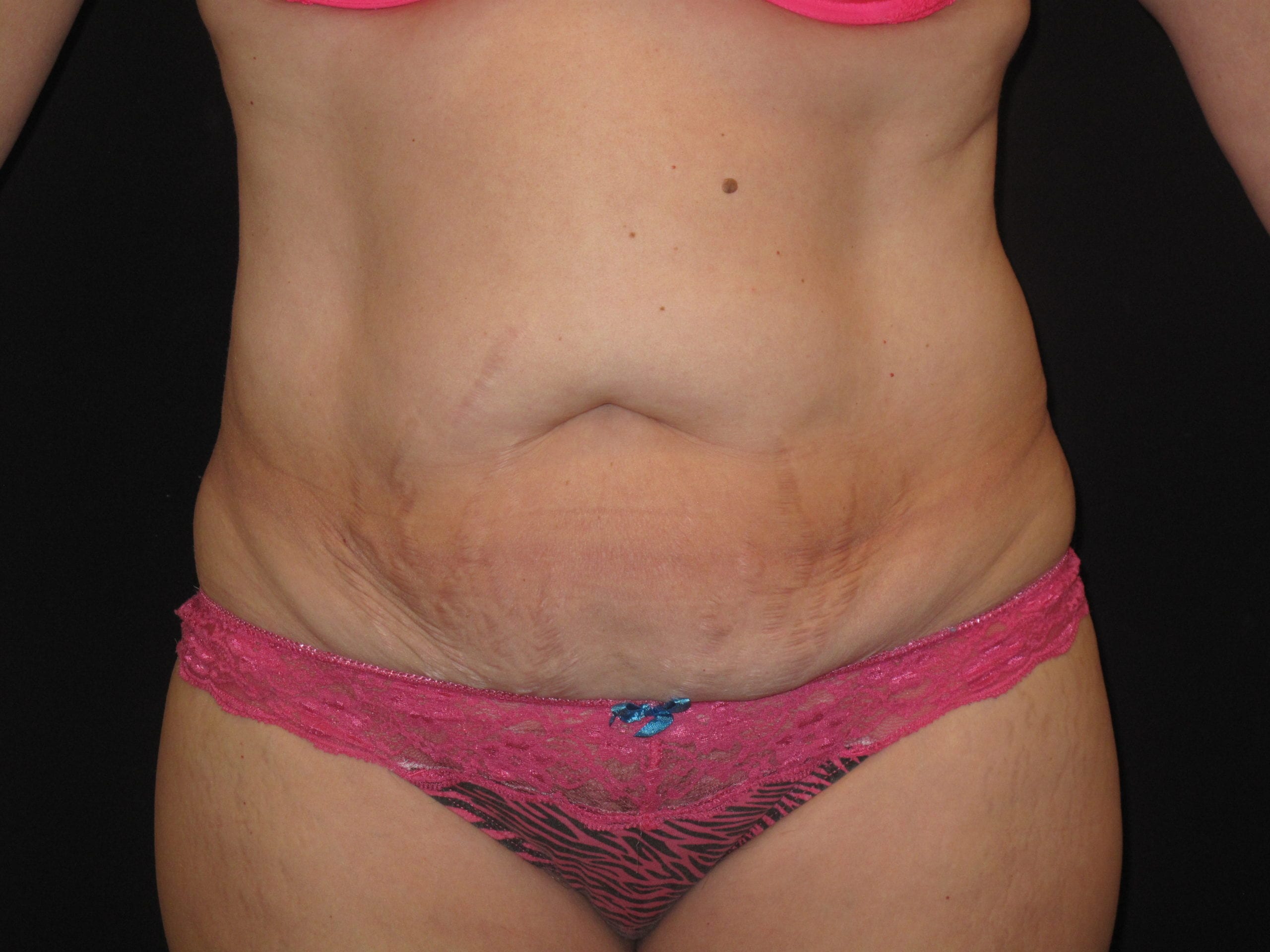 Tummy Tuck Patient Photo - Case Case 9 - before view-0