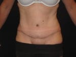 Tummy Tuck - Case Case 9 - After