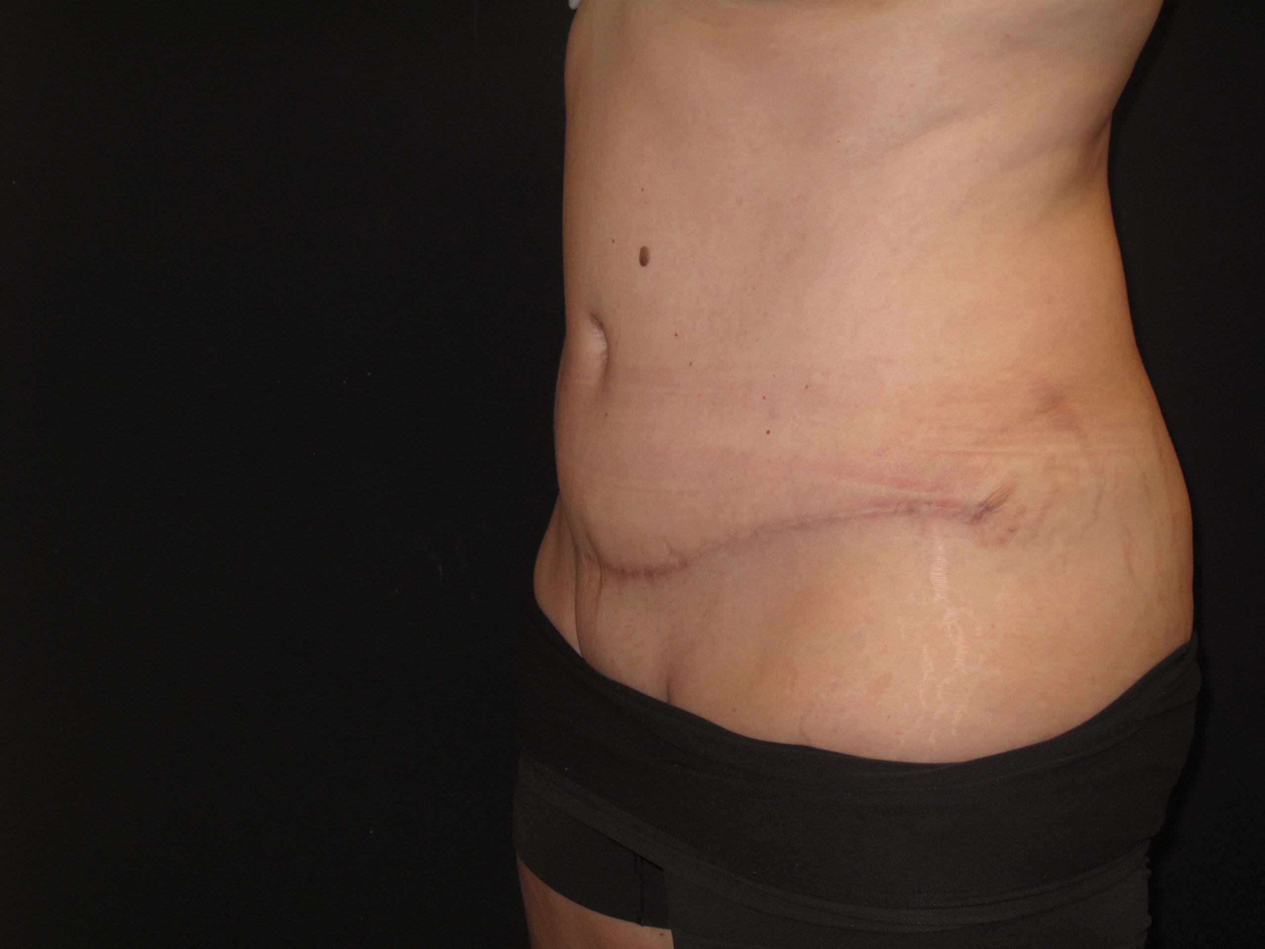Tummy Tuck Patient Photo - Case Case 9 - after view-1
