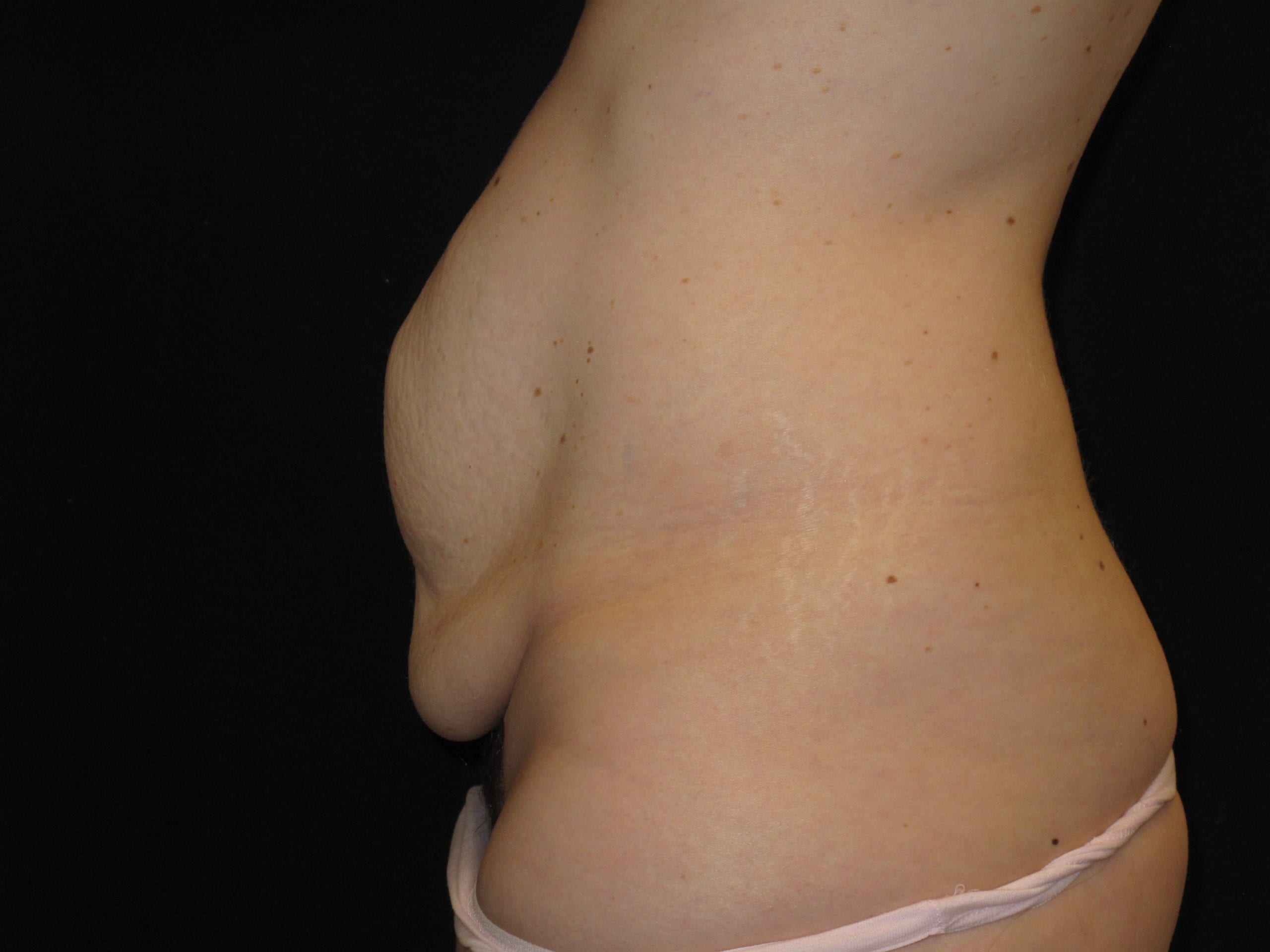 Tummy Tuck Patient Photo - Case Case 10 - before view-1