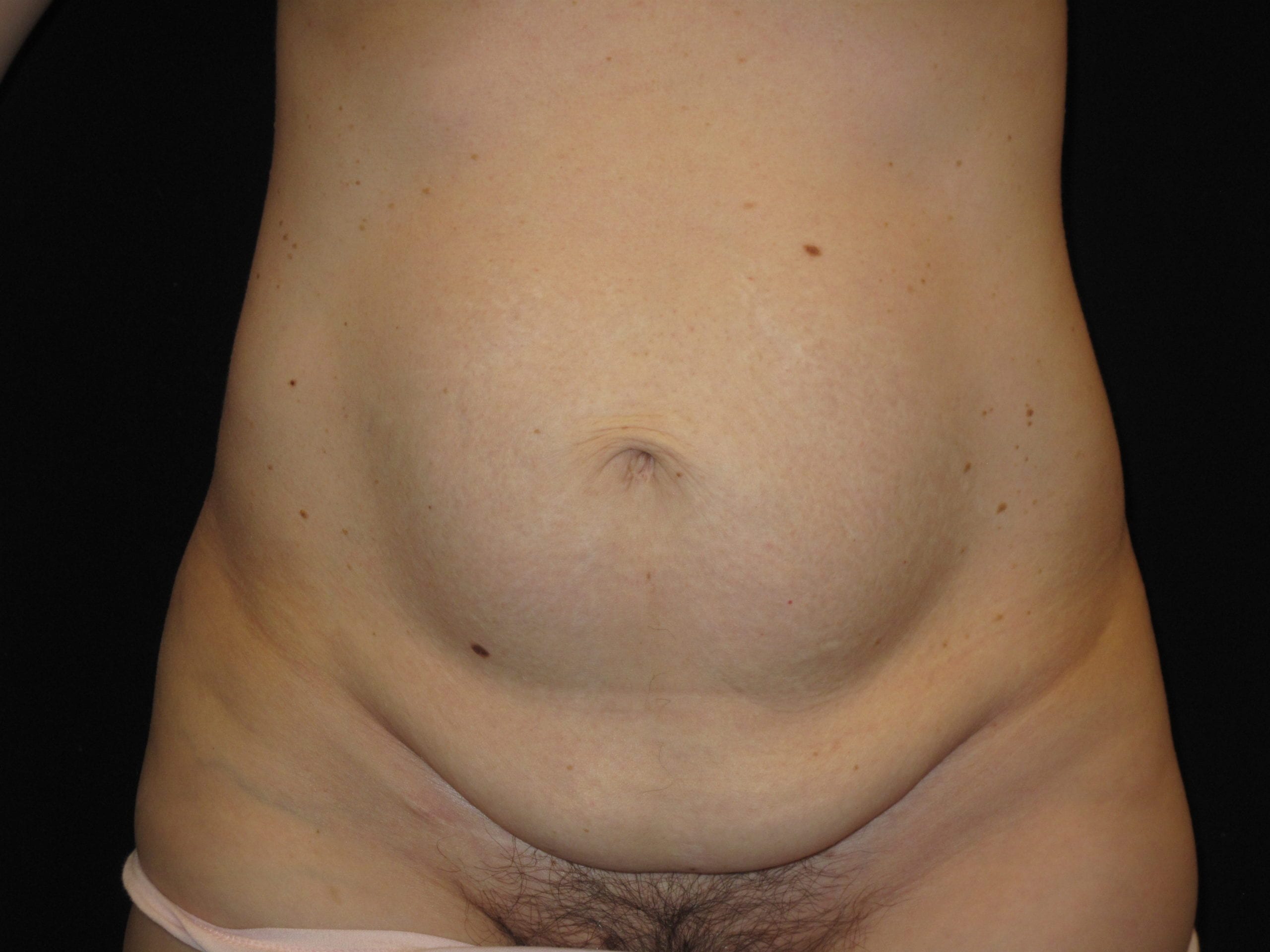 Tummy Tuck Patient Photo - Case Case 10 - before view-