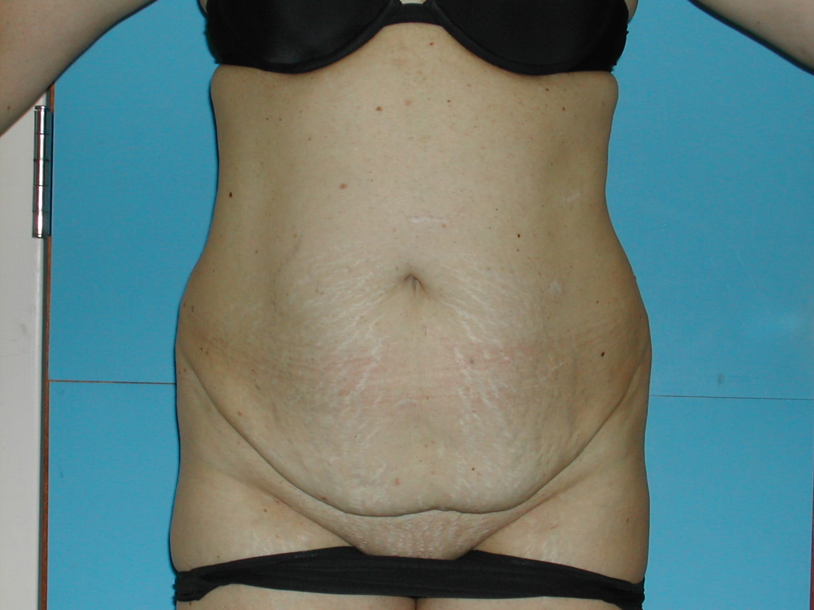 Tummy Tuck Patient Photo - Case Case 1 - before view-0