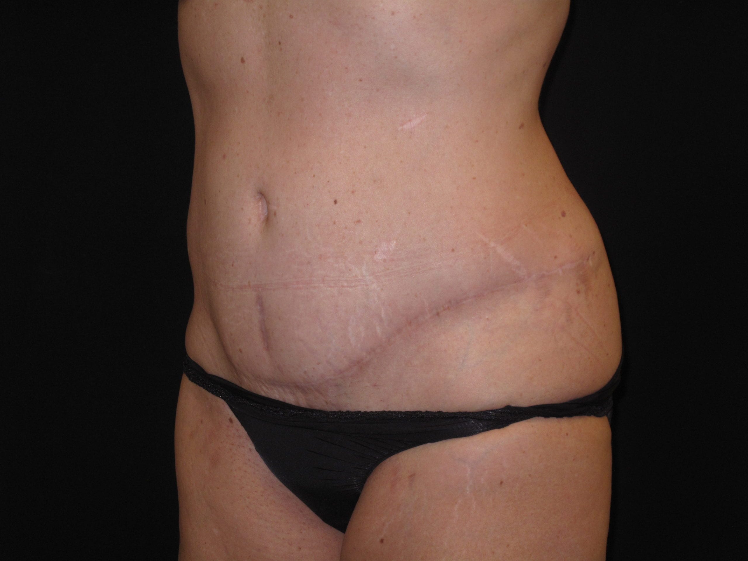 Tummy Tuck Patient Photo - Case Case 1 - after view-1