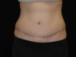 Tummy Tuck - Case Case 5 - After