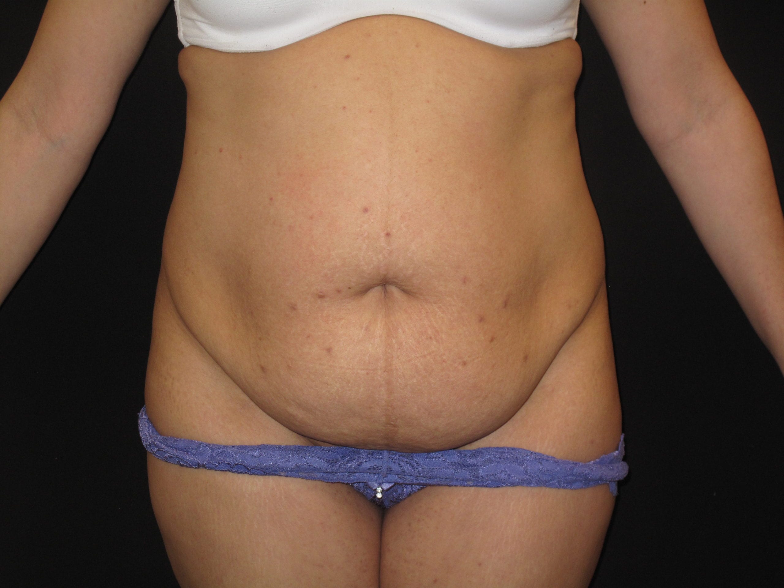 Tummy Tuck Patient Photo - Case Case 11 - before view-
