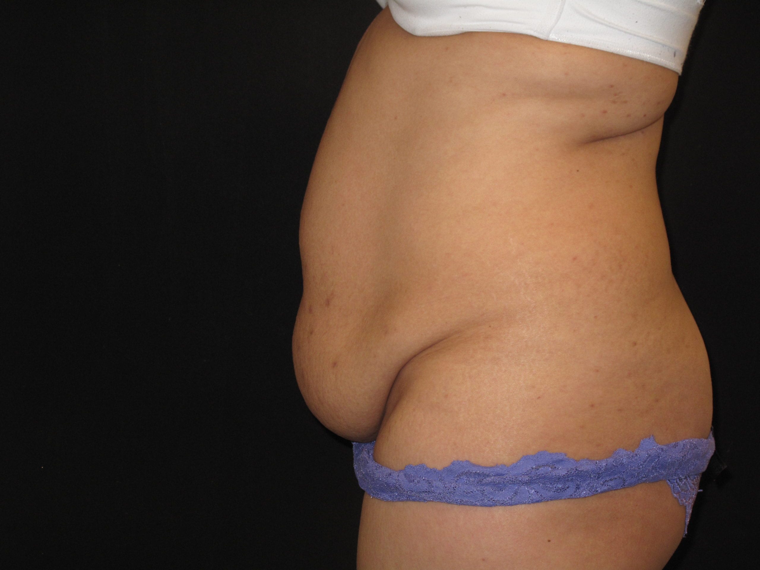 Tummy Tuck Patient Photo - Case Case 11 - before view-1