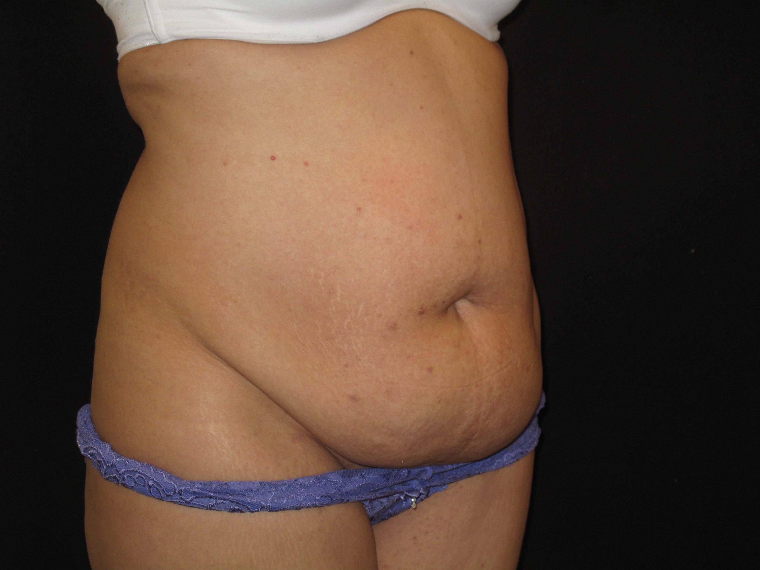Tummy Tuck Patient Photo - Case Case 11 - before view-2
