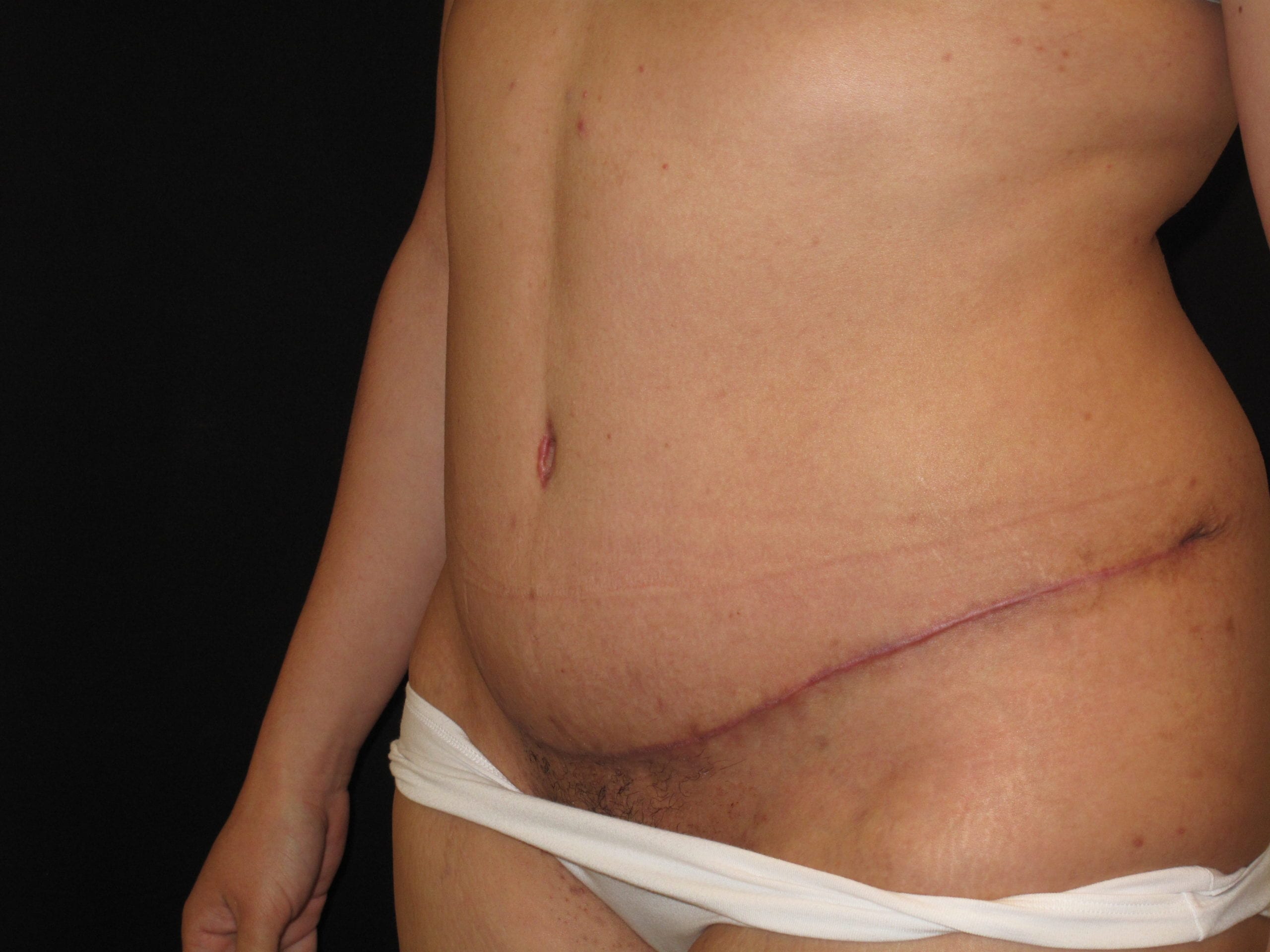 Tummy Tuck Patient Photo - Case Case 11 - after view-1