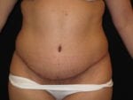 Tummy Tuck - Case Case 11 - After