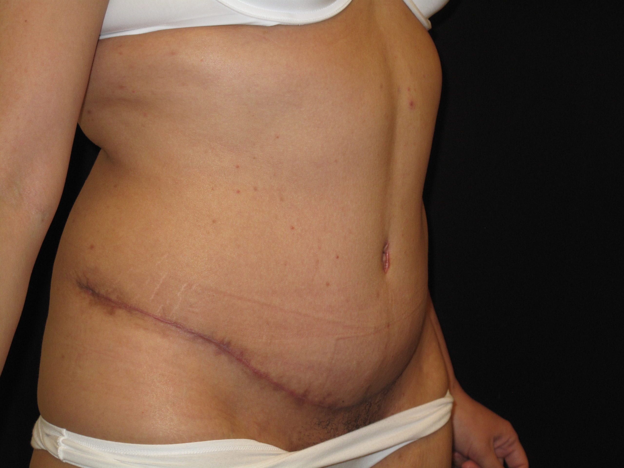 Tummy Tuck Patient Photo - Case Case 11 - after view-2