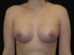 Breast Augmentation - Case Case 43 - After