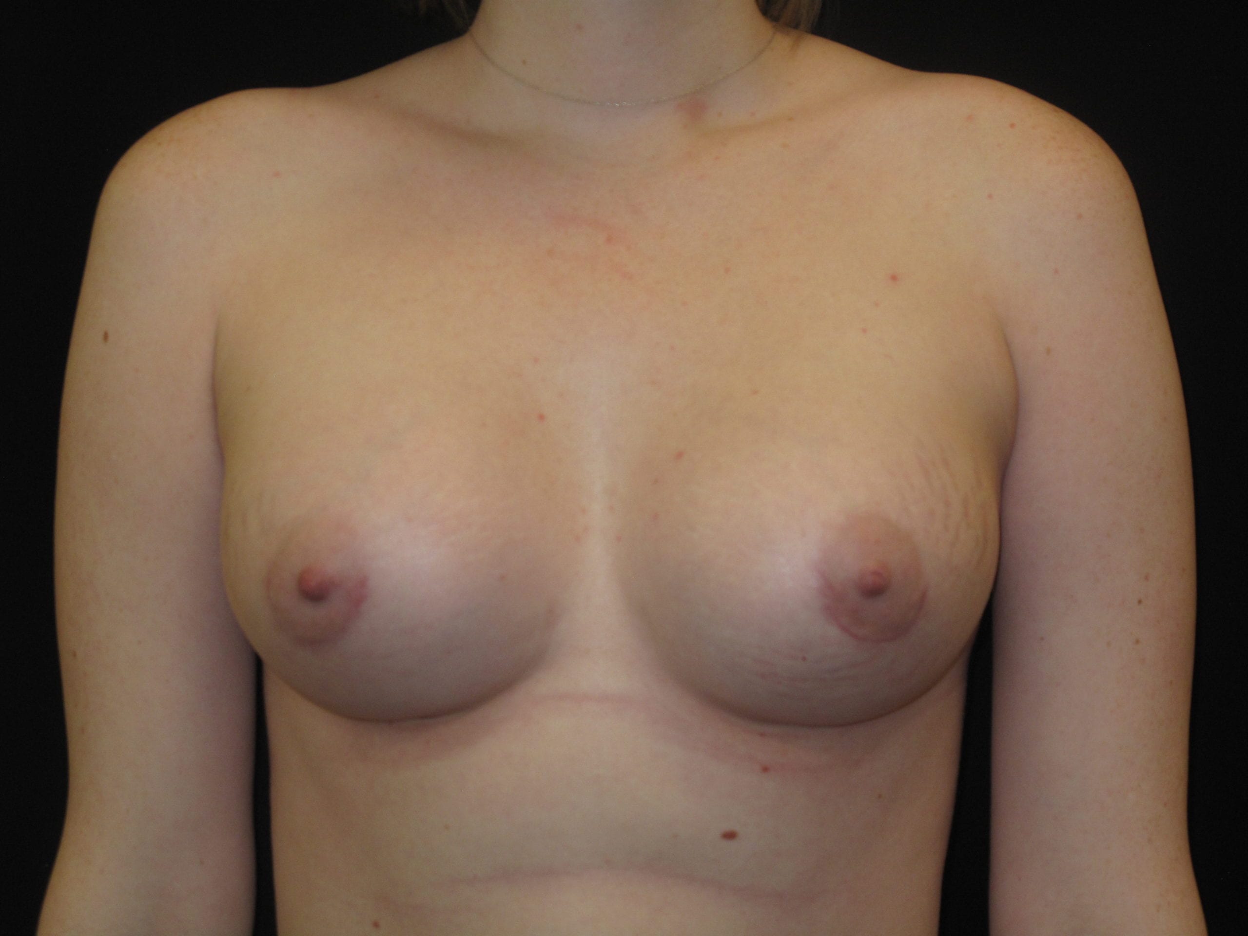 Breast Augmentation Patient Photo - Case Case 43 - after view