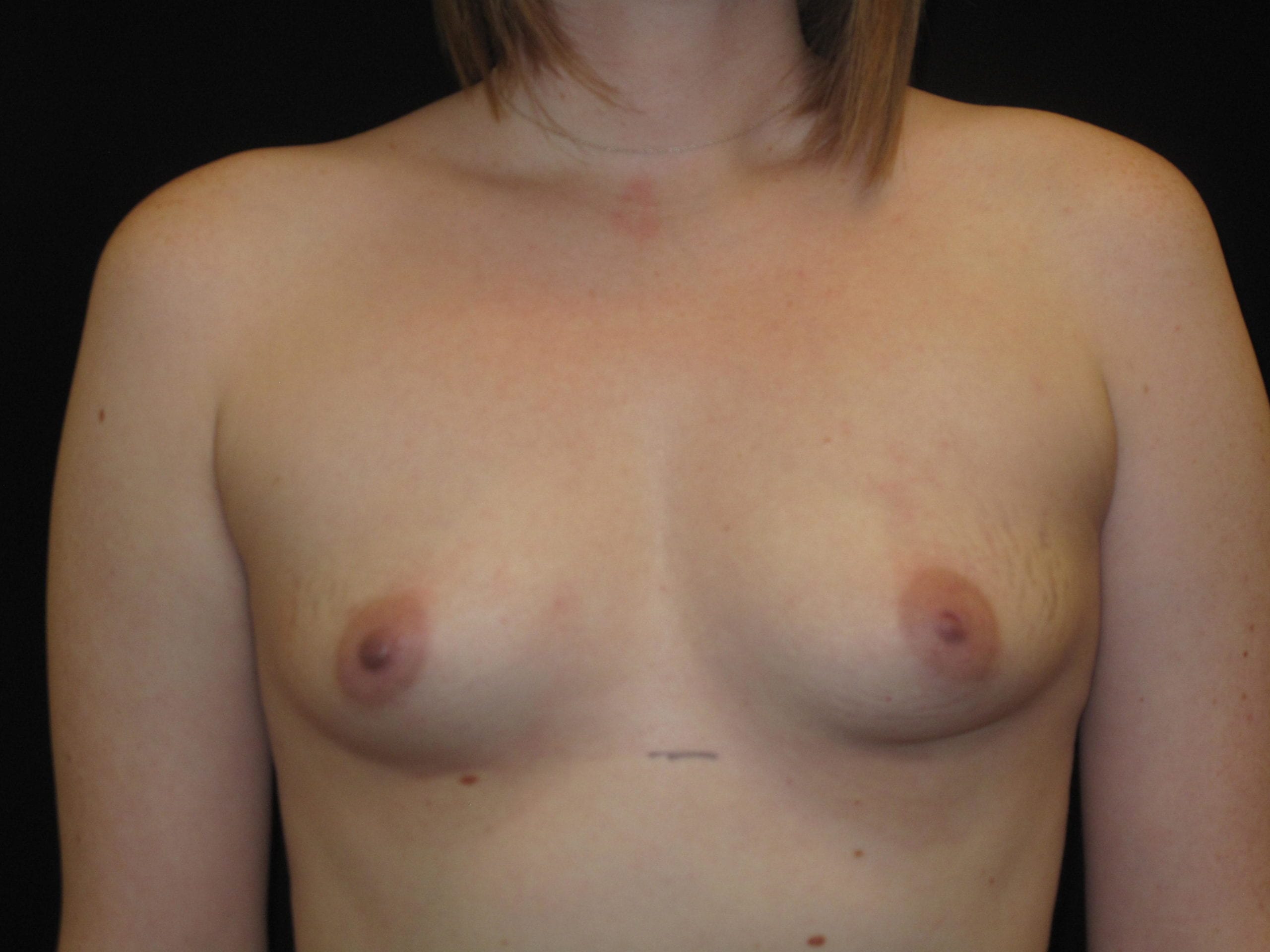 Breast Augmentation Patient Photo - Case Case 43 - before view-