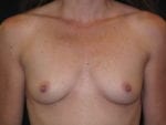 Breast Augmentation - Case Case 44 - Before