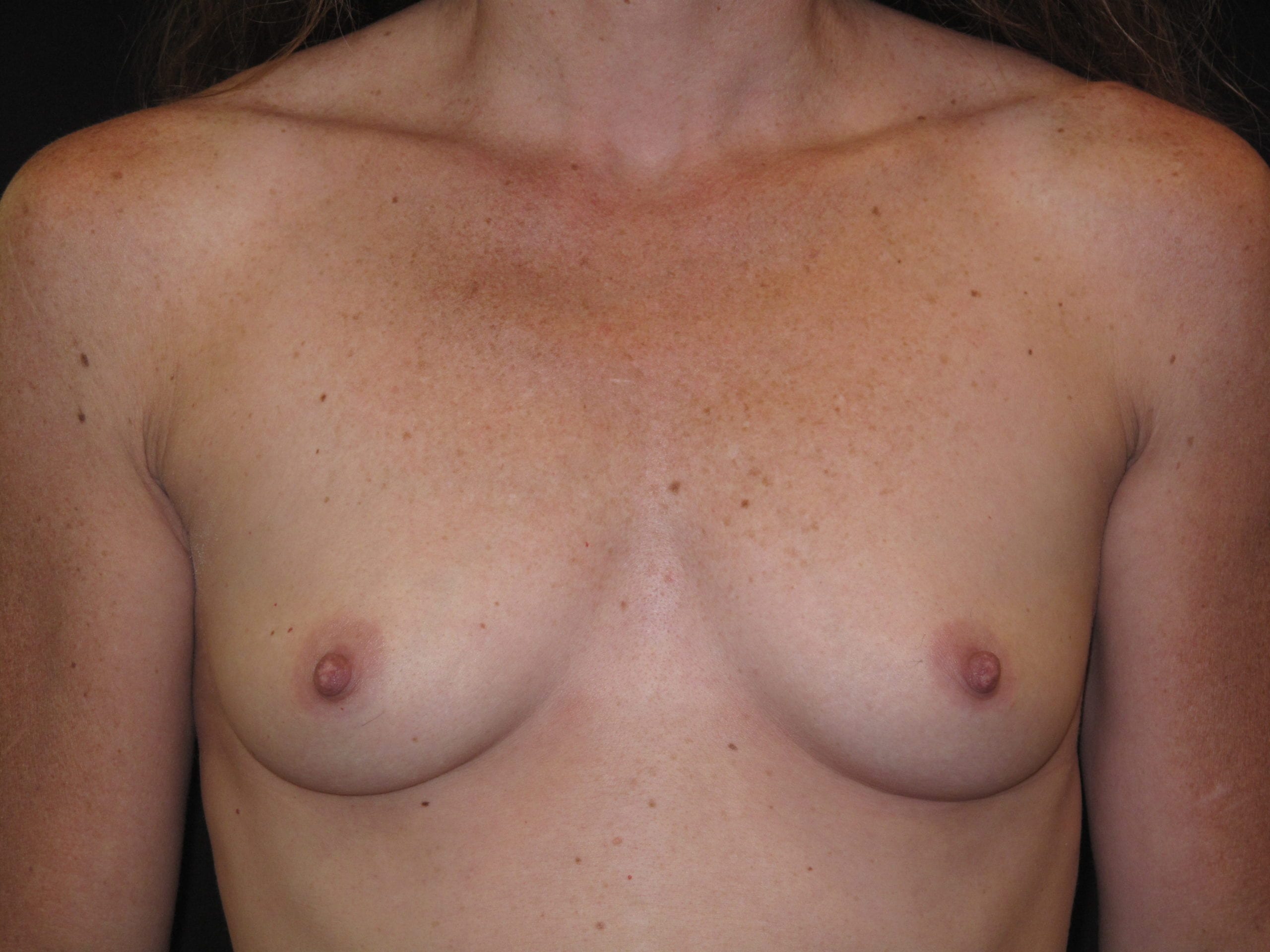 Breast Augmentation Patient Photo - Case Case 44 - before view-0