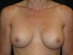 Breast Augmentation - Case Case 44 - After