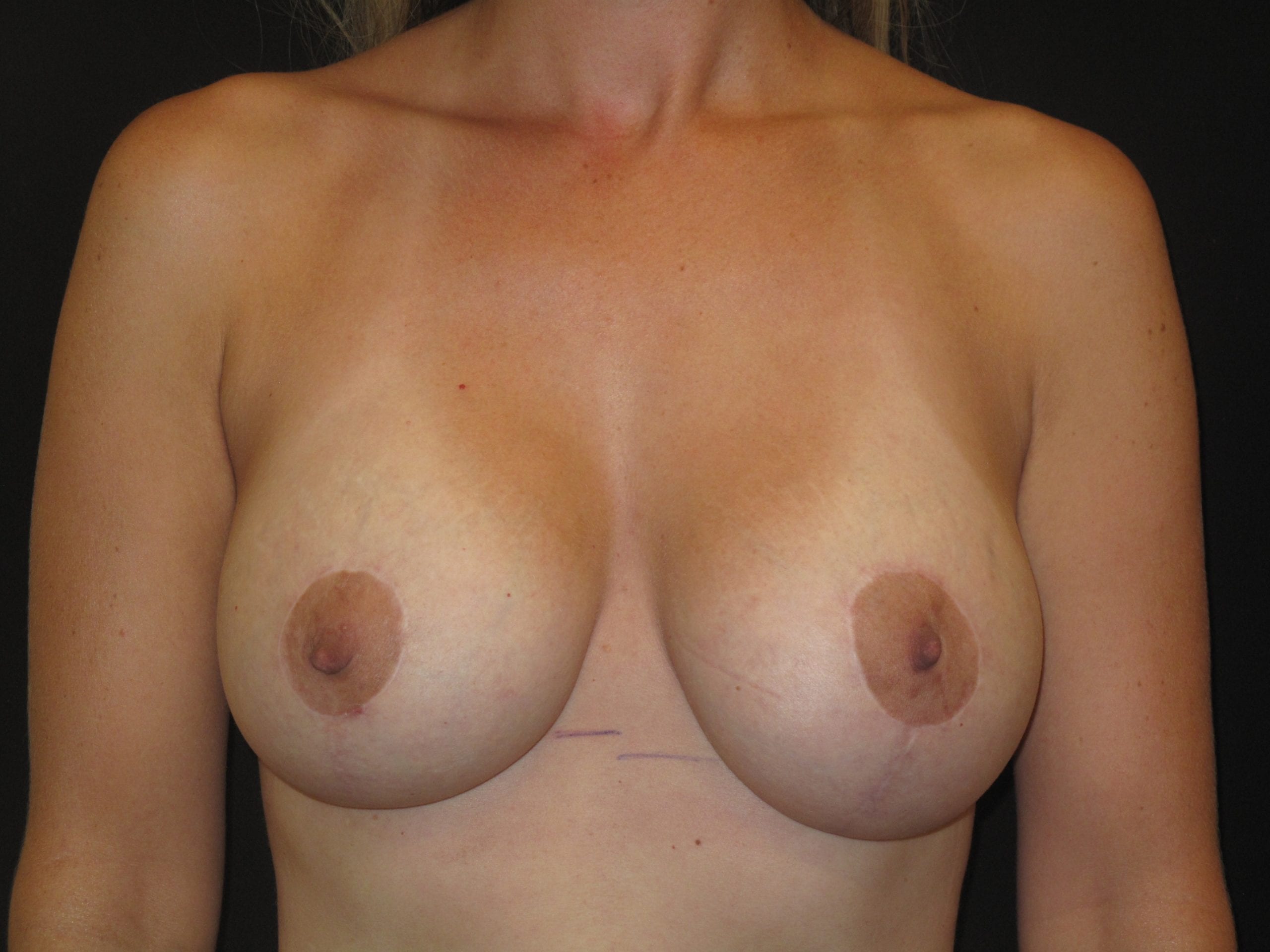 Breast Lift w/ Augmentation Patient Photo - Case Case 16 - after view