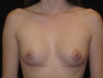 Breast Augmentation - Case Case 45 - Before