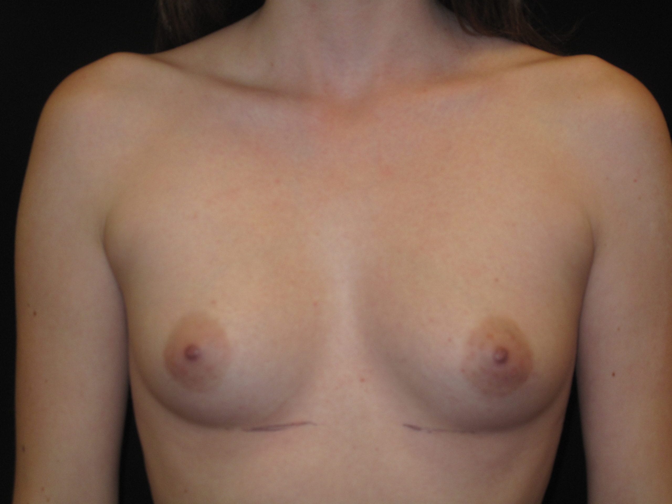Breast Augmentation Patient Photo - Case Case 45 - before view-