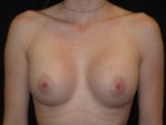 Breast Augmentation - Case Case 45 - After