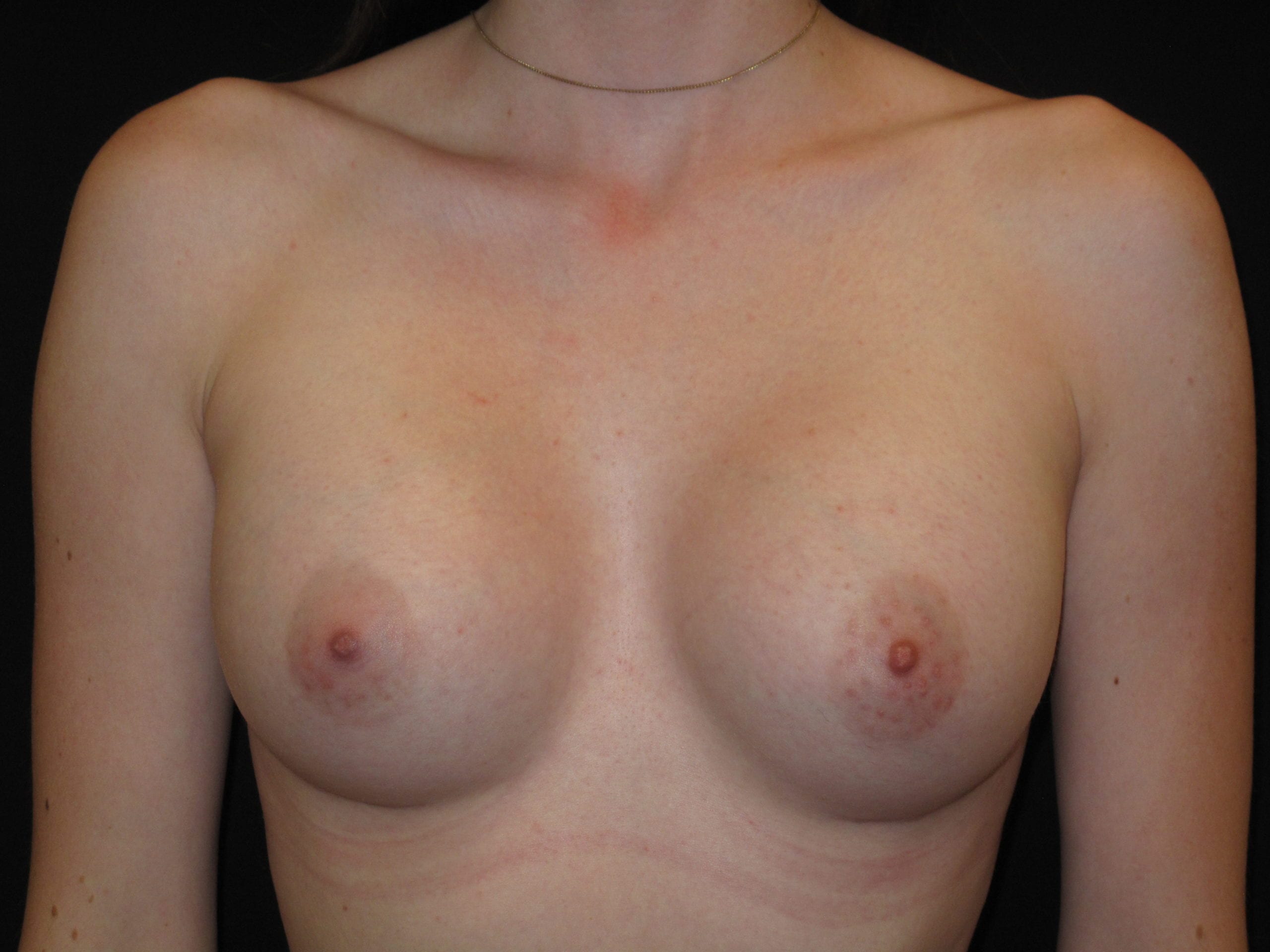 Breast Augmentation Patient Photo - Case Case 45 - after view-0