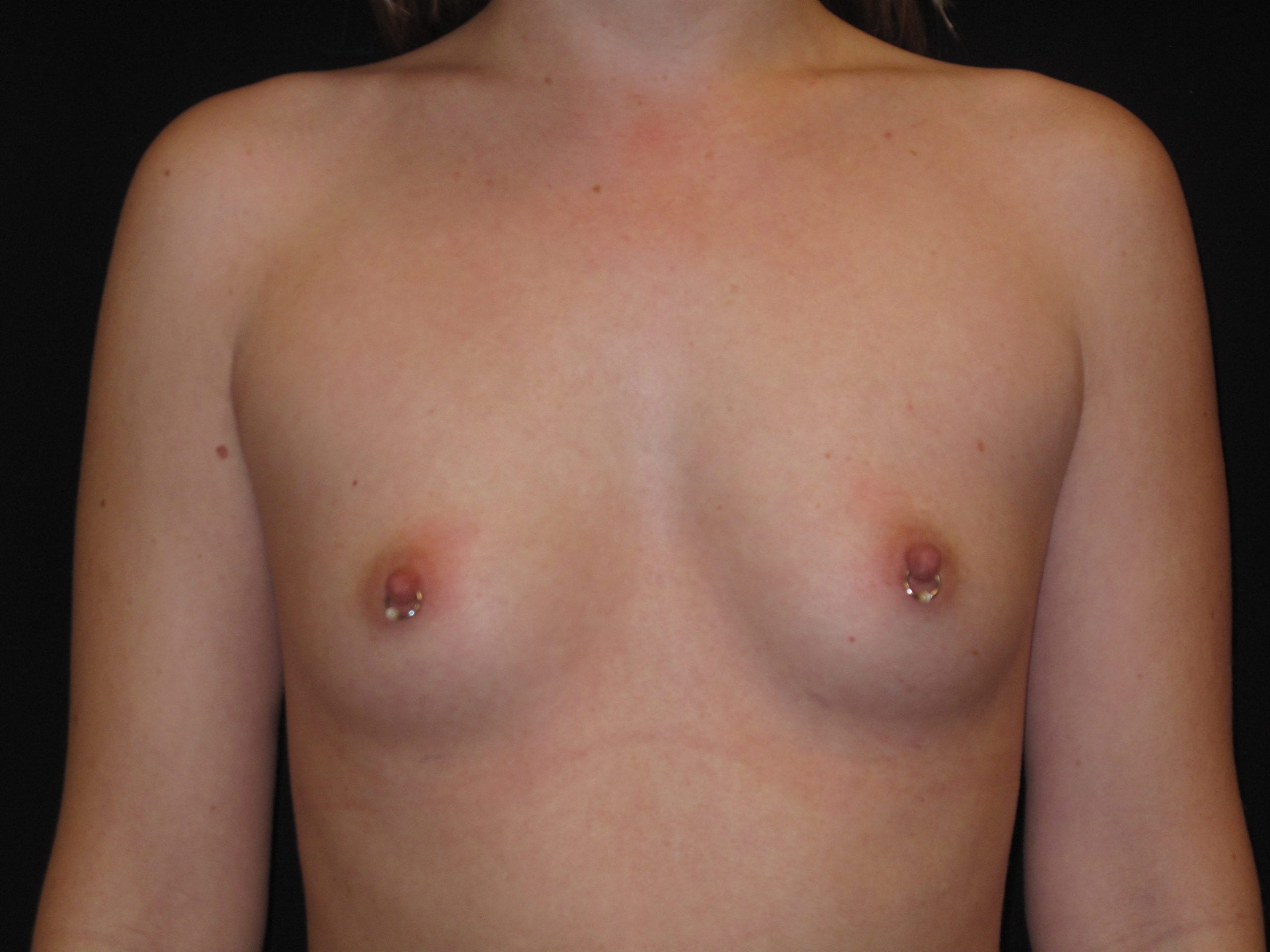 Breast Augmentation Patient Photo - Case Case 46 - before view-