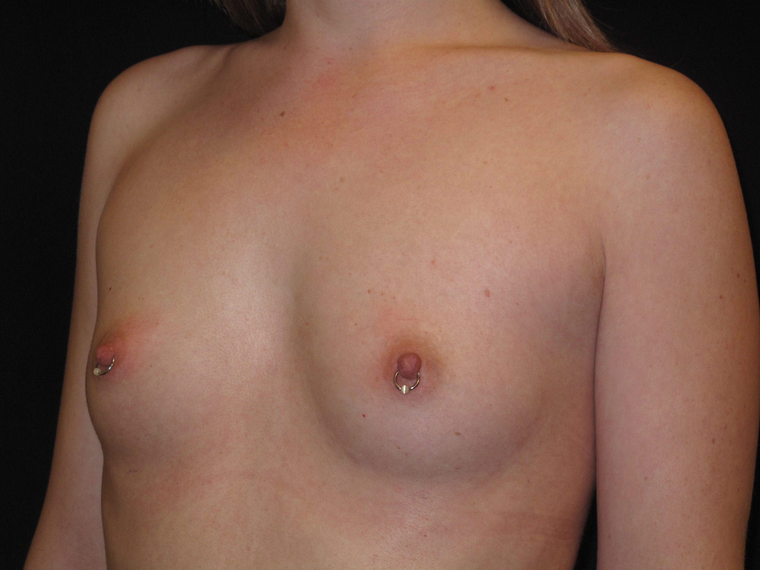 Breast Augmentation Patient Photo - Case Case 46 - before view-1
