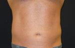 Coolsculpting - Case Case 5 - After