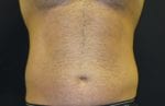 Coolsculpting - Case Case 5 - Before