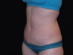 Coolsculpting - Case Case 6 - After