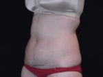 Coolsculpting - Case Case 6 - Before