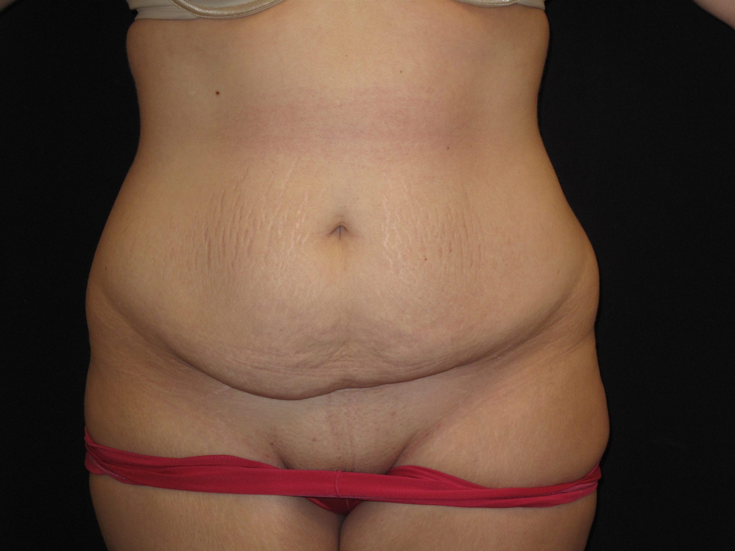Tummy Tuck Patient Photo - Case Case 12 - before view-