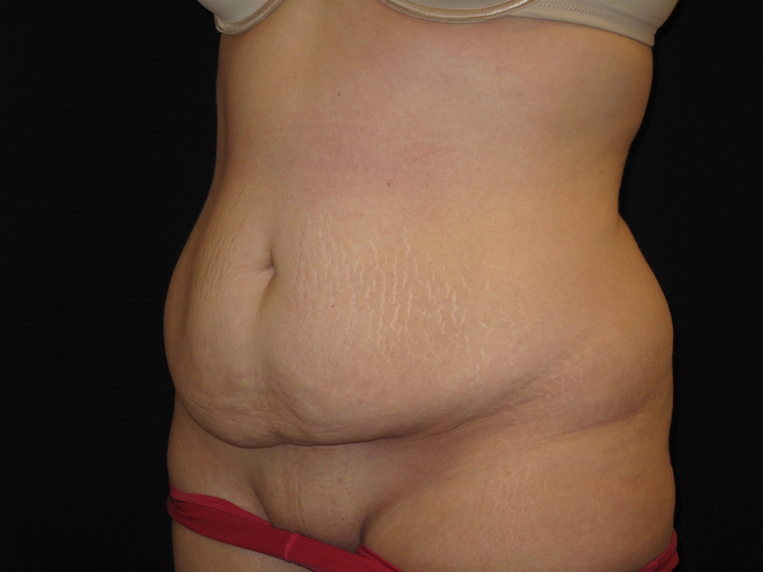 Tummy Tuck Patient Photo - Case Case 12 - before view-1