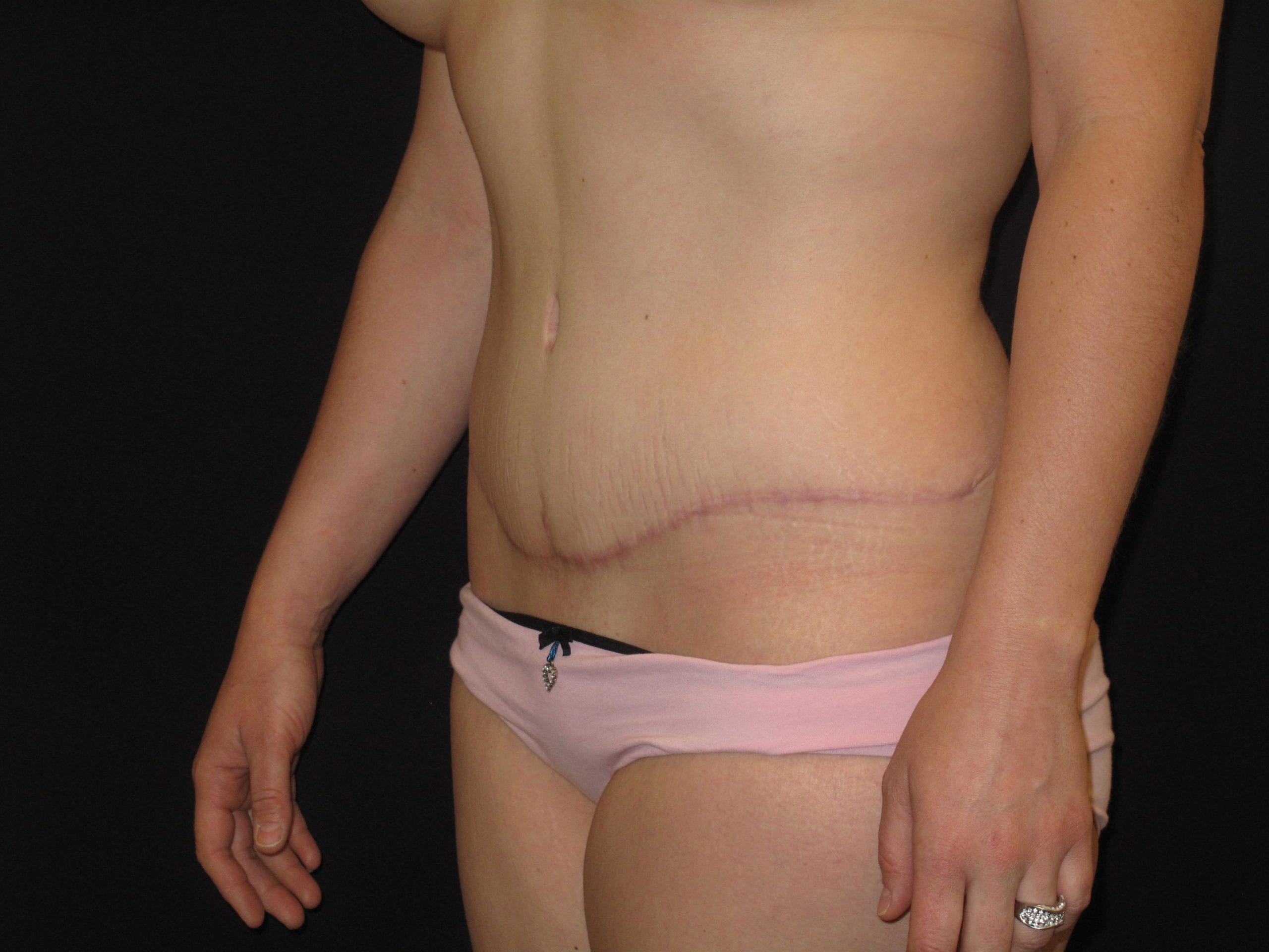 Tummy Tuck Patient Photo - Case Case 12 - after view-1