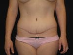 Tummy Tuck - Case Case 12 - After