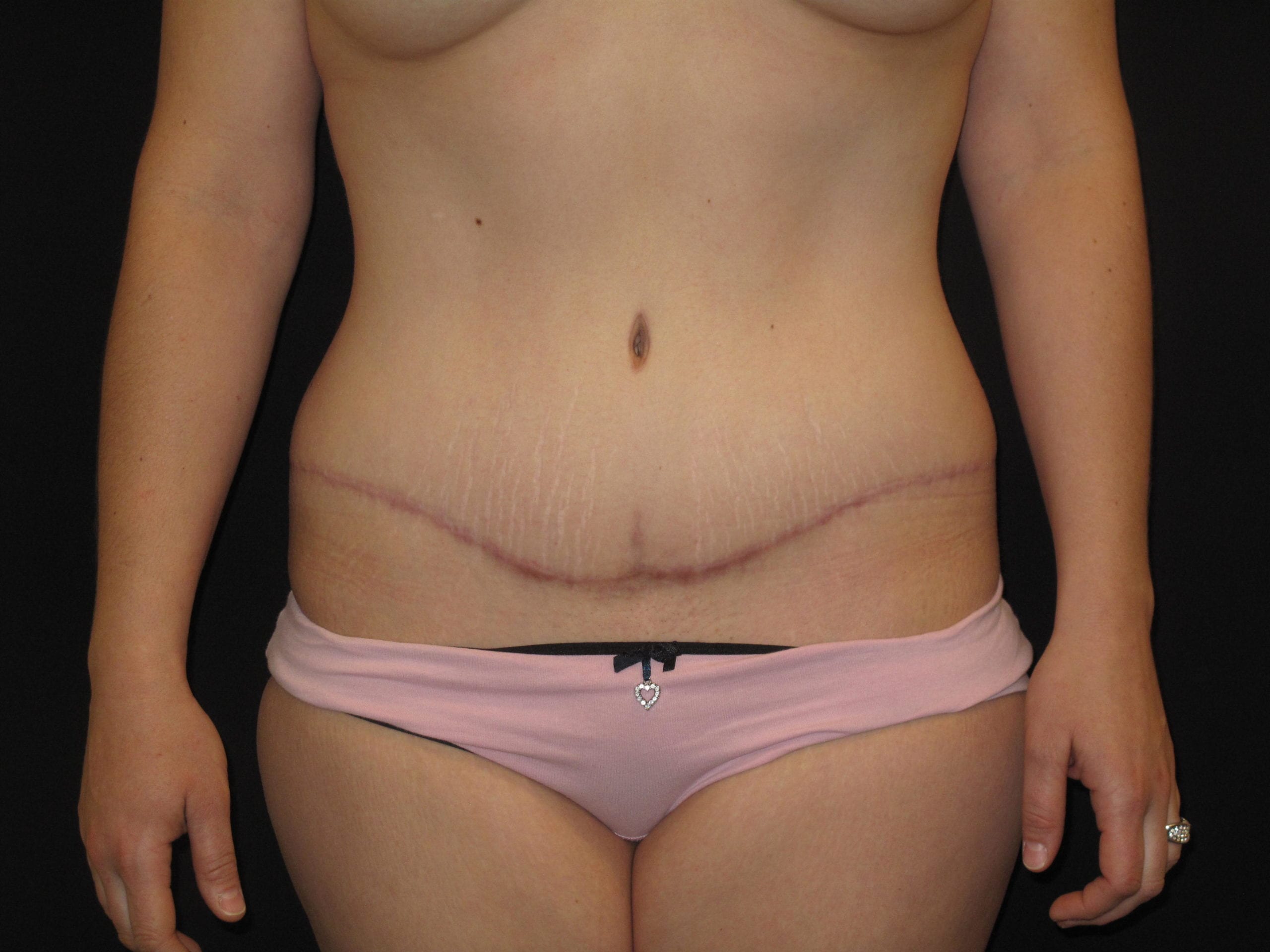 Tummy Tuck Patient Photo - Case Case 12 - after view-0