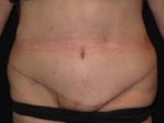 Tummy Tuck - Case Case 13 - After